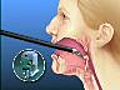 Robotic Tongue Cancer Surgery | BahVideo.com