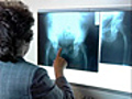 Treating Osteoporosis | BahVideo.com