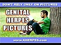 Female Genital Herpes Pictures | BahVideo.com
