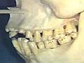 Lecture 32 - Nerve Supply to Teeth Maxillary  | BahVideo.com
