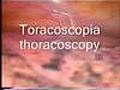 Effetti del fumo- Toracoscopia- I POLMONI  | BahVideo.com