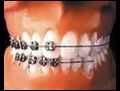Ortodontik tedavi g ren kisi nelere dikkat etmeli  | BahVideo.com
