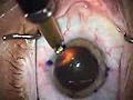 Modern Cataract Surgery Alcon ReSTOR IOL with LRI | BahVideo.com