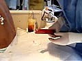 Thoracocentesis Removing 1200CC Pleural Fluid | BahVideo.com