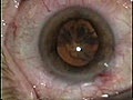Cataract Operation | BahVideo.com