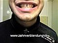 Zahnersatz Veeners Gebiss Zahnverblendung Prothese | BahVideo.com