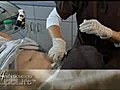 Aesthetic Medicine - LIPOLIFT | BahVideo.com