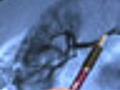 Nerve Surgery | BahVideo.com