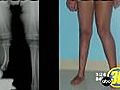 Lengthening Legs | BahVideo.com