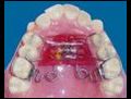 Ortodontide hangi tip dis telleri kullanilir  | BahVideo.com