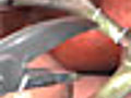 Gallbladder Surgery Animation | BahVideo.com