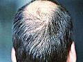 Saç ekimi aci veren bir islem mi? | BahVideo.com