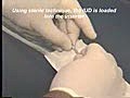 IUD Insertion | BahVideo.com