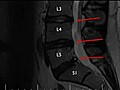 disc herniation and how to heal it naturally  | BahVideo.com