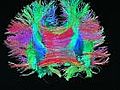 Superfast MRI technology helps map human brain | BahVideo.com