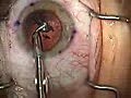 Modern Cataract Surgery Alcon ReSTOR IOL with LRI | BahVideo.com