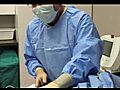 Finishing Tickle Lipo Procedure | BahVideo.com