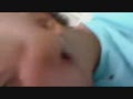 Huge Splinter Goes Through Guys Head And Pops  | BahVideo.com