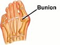 Bunions - Podiatrist in Myrtle Beach Conway  | BahVideo.com