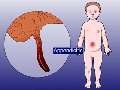 Symptoms of Appendicitis in Babies and Children | BahVideo.com