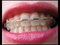 Ortodonti aci veren bir tedavi y ntemi mi  | BahVideo.com