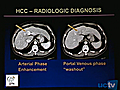 UCSF 2010 Liver Transplant Hepatocellular Carcinoma and Iron Overload | BahVideo.com