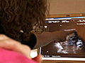 Strange Pregnancy Abdominal Pregnancy | BahVideo.com