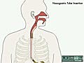 Animation on Nasogastric Tube | BahVideo.com