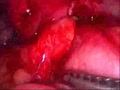 Large Bowel Epiploica Laparoscopic Resection | BahVideo.com