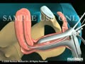 Endometrial Biopsy of Uterus | BahVideo.com