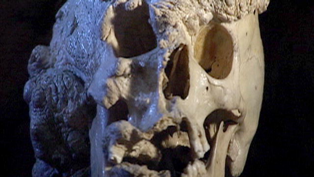 Curse of the Elephant Man Skull MRI | BahVideo.com