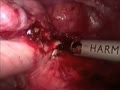 Total Hysterectomy Laparoscopic HD | BahVideo.com