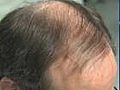Link between baldness and cancer | BahVideo.com