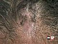  Video Hair transplants for women | BahVideo.com