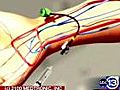 New twist to heart stents | BahVideo.com