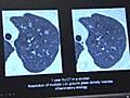 Study CT screening cuts lung cancer deaths | BahVideo.com