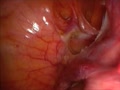 Laparoscopic Supracervical Hysterectomy | BahVideo.com