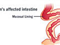 How Crohn s Disease Is Treated | BahVideo.com