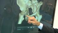 High-tech equipment helps fix bone injuries | BahVideo.com