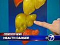 Fatty liver disease | BahVideo.com