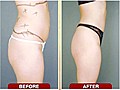 Why are thin fit women getting liposuction  | BahVideo.com