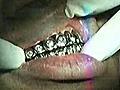 Throwback Footage Of The Week Birdman Showing How To Get 100K Platinum Grill Drilled In By Dentist  | BahVideo.com