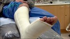 VIDEO Could this be the end of plaster casts  | BahVideo.com