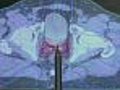Finger Length Could Determine Prostate Cancer Risk | BahVideo.com