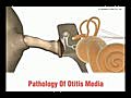 Ottitis Media Pathology | BahVideo.com