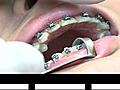 5 Tips to Save on Braces | BahVideo.com
