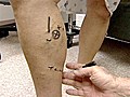 Varicose Vein Removal Now Simplified With New | BahVideo.com