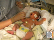 EXIT procedure saves babies amp 039 lives | BahVideo.com