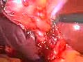Laparoscopic Cholecystectomy | BahVideo.com