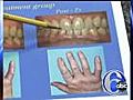 Link between gum disease and arthritis | BahVideo.com
